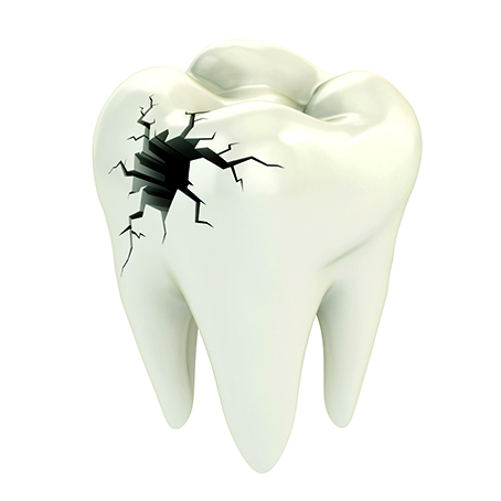 تآكل الأسنان... الأسباب والوقاية والعلاج